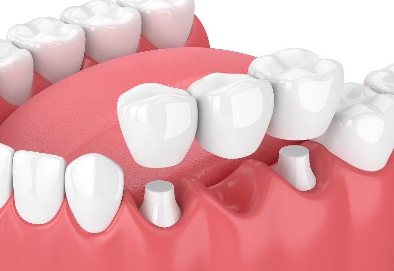 Dental bridge treatment placed over prepared teeth to replace a missing tooth in Warrenville, IL